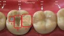 Gambar 2. Gigi beserta tambalan gigi.