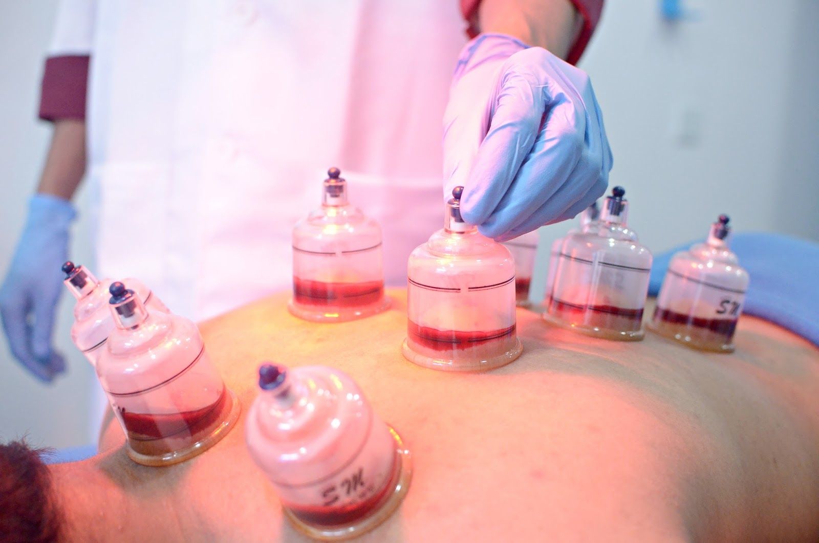 Jarum, alat, terapis, harus steril dalam bekam (foto: potretriau.com)