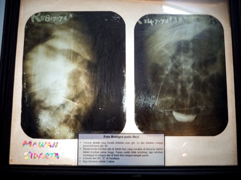 Hasil foto ronsen yang membuktikan keberadaan ilmu santet (dok. Mawan Sidarta) 