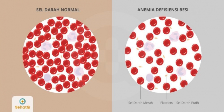 Gambar 2. Perbedaan Sel darah Normal dan Penderita Anemia Defisiensi Besi (Sumber : https://www.sehatq.com)
