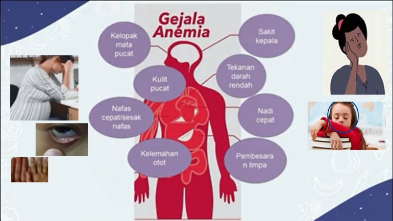 Grafis terkait gejala anemia merupakan materi webinar Danone Indonesia, disunting seperlunya oleh penulis.