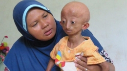 Kejadian Progeria juga ditemui di Aceh (Foto: tribunnews.com)