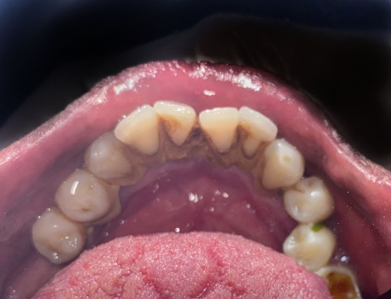 Gambar 4. Terlihat akar gigi terekspos (sesuai panah merah) akibat adanya akumulasi karang gigi yang menyebabkan gusi turun.