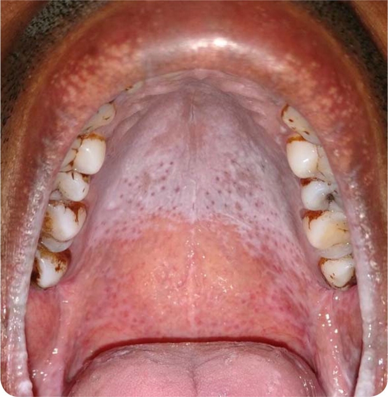 Sumber: American Family Physician, Gambar 5. Terlihat bintik-bintik merak di area langit-langit mulut pada seorang perokok
