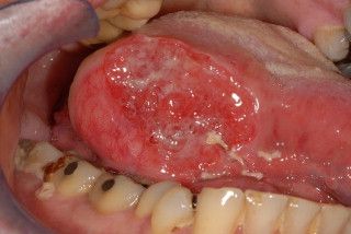 sumber: British Journal of Oral and Maxillofacial Surgery, Gambar 6. Karsinoma sel skuamosa pada lidah 