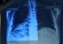 Hasil foto thorax : pneumonia bilateral/koleksi pribadi