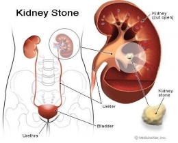kedney stone/flick