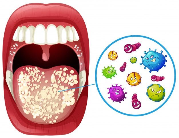 Ilustrasi kondisi rongga mulut yang dipenuhi kuman. sumber: Freepik