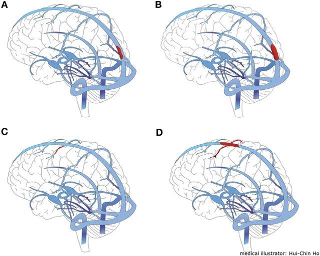 Berbagai tipe Sumber: cerebral venous sinus thrombosis (CVST). Sumber: NatureResearch