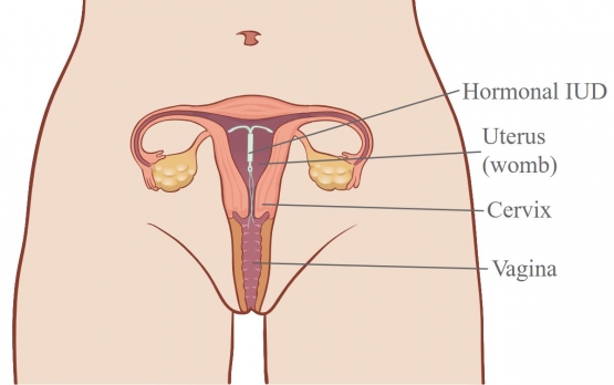 Ilustrasi IUD yang tertanam di dalam rahim - foto: www.fpv.org.au