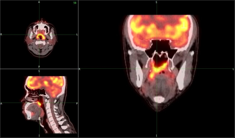 Ilustrasi Hasil PET Scan kepala dan leher untuk kanker nasofaring. Sumber: Sandjaja Kosasih