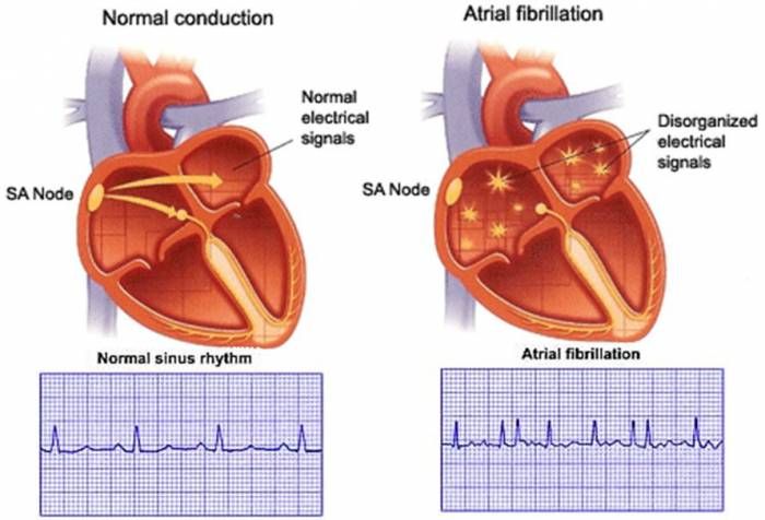 Ilustrasi detak jantung. Source image: kauveryhospital.com