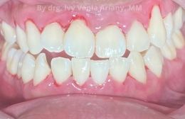 Ini adalah kondisi gigi setelah dilakukan pembersihan karang gigi. Terlihat banyak gusi yang sudah turun.-sumber: data pribadi