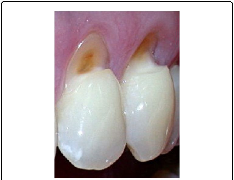 Bagian gigi yang mendekati gusi menjadi terekspos karena gigi mengalami tekanan yang berlebihan-sumber: Researchgate