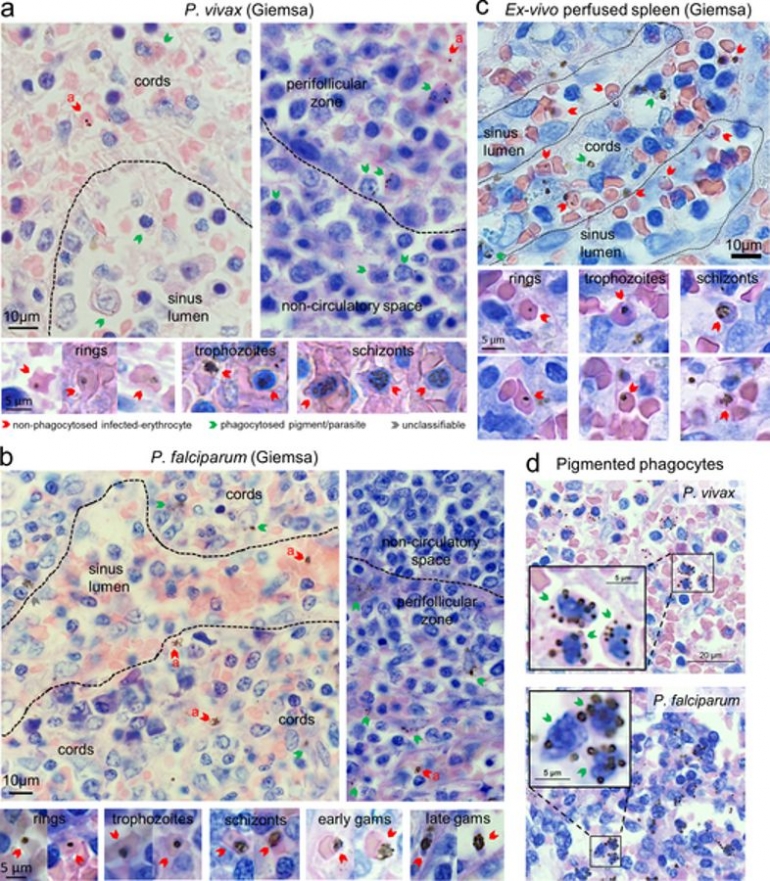 Bukti keberadaan parasit malaria di limpa yang menghebohkan dunia. Sumber: Kho S, Qotrunnada L, Leonardo L, Andries B, Wardani PAI, et al. (2021) Evaluation of splenic accumulation and colocalization of immature reticulocytes and Plasmodium vivax in asymptomatic malaria: A prospective human splenectomy study. PLOS Medicine 18(5): e1003632. https://doi.org/10.1371/journal.pmed.1003632 journals.plos.org/plosmedicine