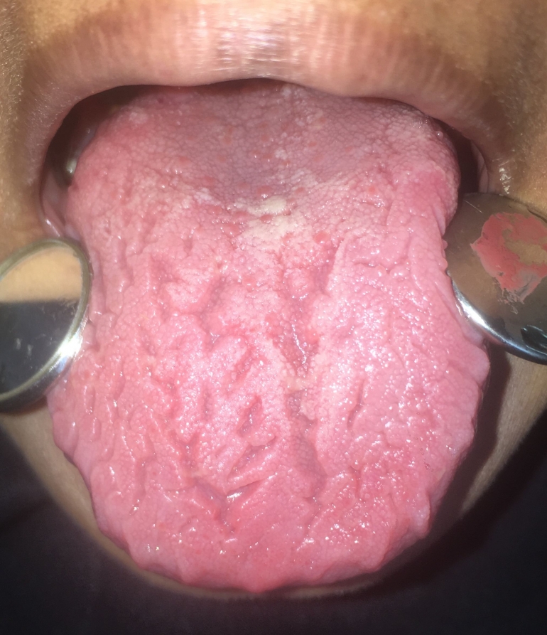 Ilustrasi fissured tongue
