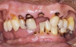 Ilustrasi lubang pada akar gigi. Terlihat warna hitam pada akar gigi