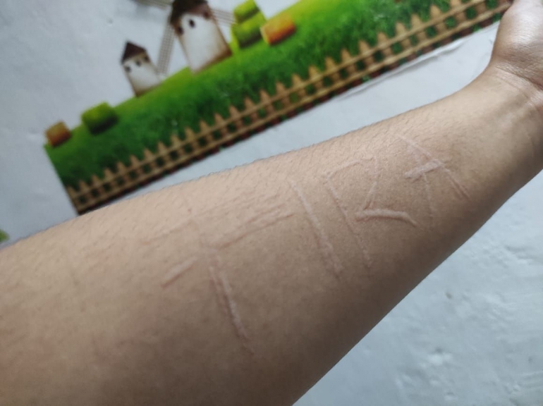 Skin Writing, Memahami Kulit Sensitif terhadap Goresan (Dermatographia ...