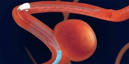 Ilustrasi aneurisma di pembuluh darah/dokumentasi RS PON