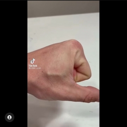 Penanaman chip pada tubuh manusia | gambar: Tiktok/@robot_scott via IG/dtech.engineering