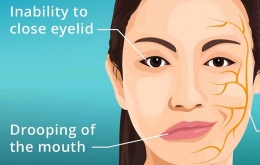 Sumber: Lifestyle-bisnis.com, Bell's Palsy