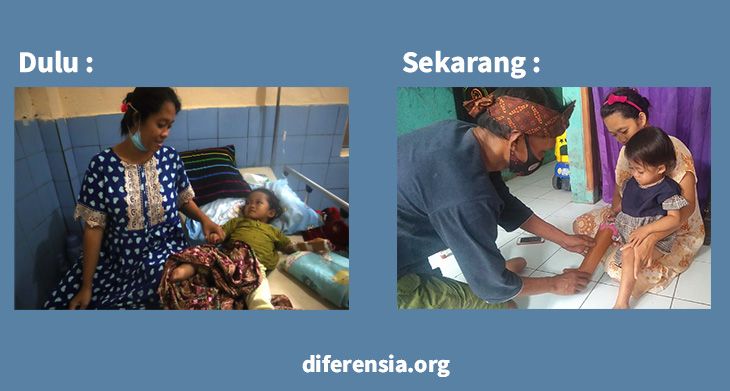 Kondisi Alika sebelum dan Sesudah mendapatkan Bantuan Kaki Palsu (diferensia.org)