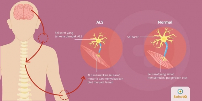 https://www.sehatq.com/penyakit/penyakit-lou-gehrig
