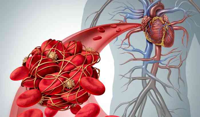 Source: https://thrombosis.org/patients/what-is-thrombosis/