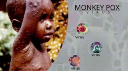 Gambaran anak yang terjangkit virus monkeypox (sumber: www.tentaran.com)