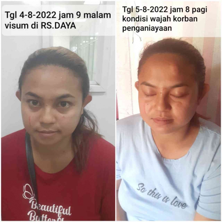 Fahnia (36) korban dugaan penganiayaan soal utang piutang di Biringkanaya, Kota Makassar (dok.pribadi)