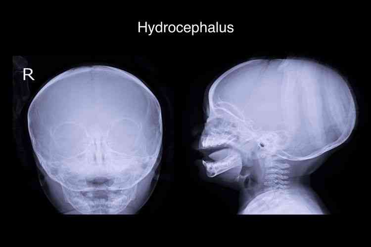 Ilustrasi hidrosefalus(Shutterstock via Kompas.com)