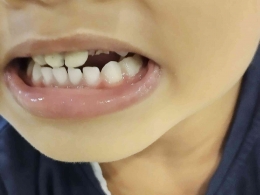Tindakan untuk gigi susu anak yang mengalami patah saat masih usia dibawah 3 tahun (foto: Akbar Pitopang)
