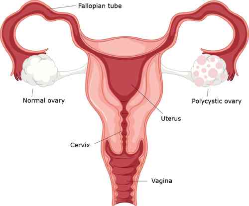 Sumber: https://www.healthdirect.gov.au/polycystic-ovarian-syndrome-pcos