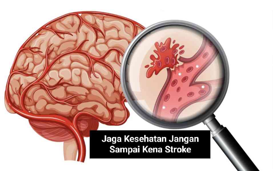 Jaga Kesehatan Jangan Sampai Kena Stroke Halaman 1 - Kompasiana.com