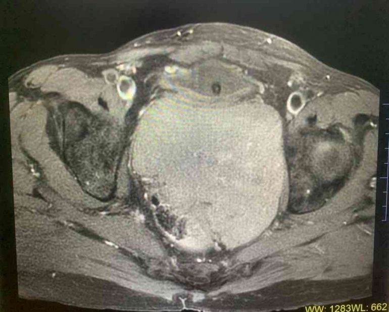 Teknik Pemeriksaan Magnetic Resonance Imaging pada Kasus Kanker Prostat ...