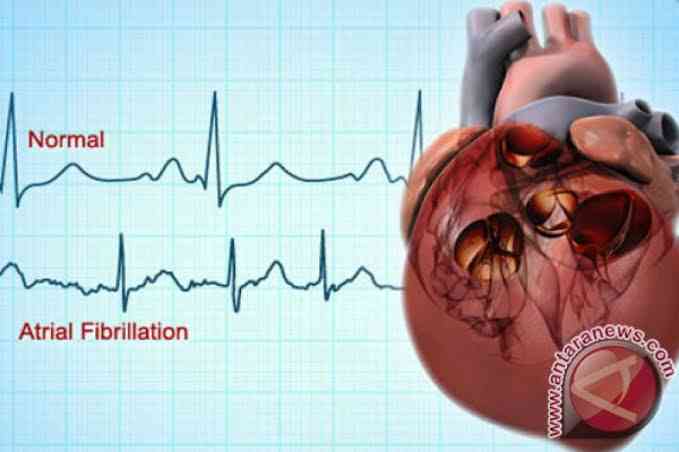 Kondisi Detak Jantung Pada Manusia | Sumber Antaranews.com