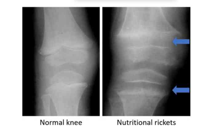 Kaki Rakhitis Defisiensi Vitamin D: Perlukah Memperhatikan Asupan Vitamin D? Halaman ...
