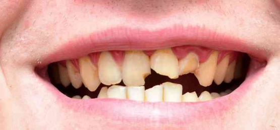 Gigi patah yang dibiarkan terlalu dapat menyebabkan gigi lain menjadi disposisi (via fdcdentalclinic.co.id)