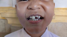 Seorang siswa kami yang mengalami patah gigi saat insiden bermain (foto Akbar Pitopang)