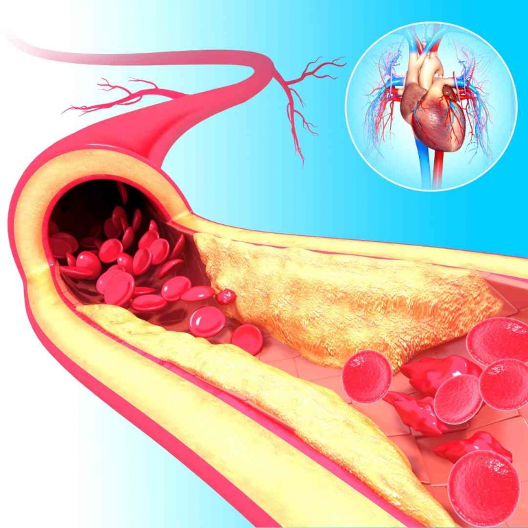 Ilustrasi penyempitan pembuluh darah yang dapat  mengganggu kerja jantung. Sumber: Freepik/Canva
