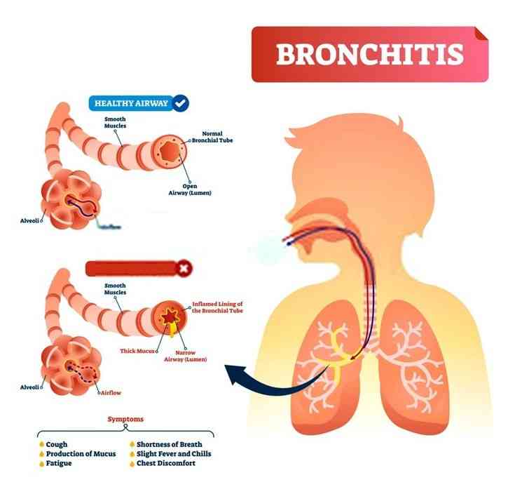 ilustrasi penyakit Bronkitis (sumber gambar  istock ban ilustrasi  pinterest.com)