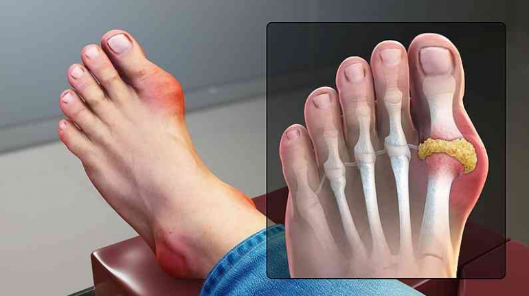 Asam urat atau gout, umumnya menyerang persendian jempol kaki. Sumber gambar: wikimedia commons.