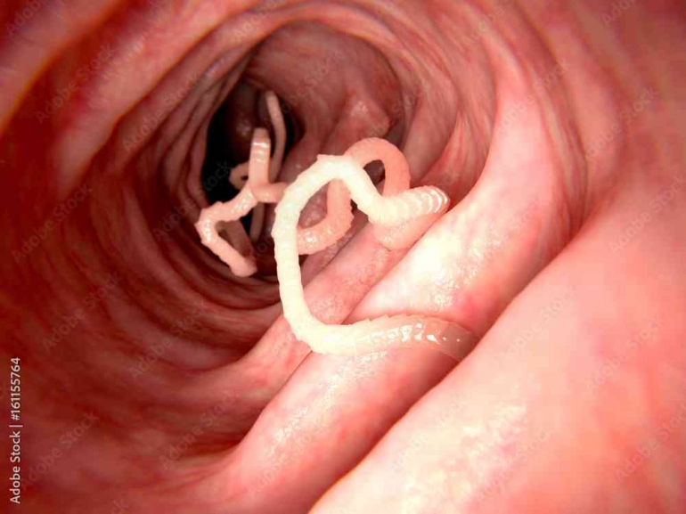 Ilustrasi cacing dan parasit yang bisa menyebabkan kanker Stock.adobe.com