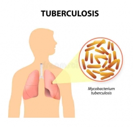 Ilustrasi infeksi Mycobacterium tuberculosis pada manusia (Foto: Dreamstime)