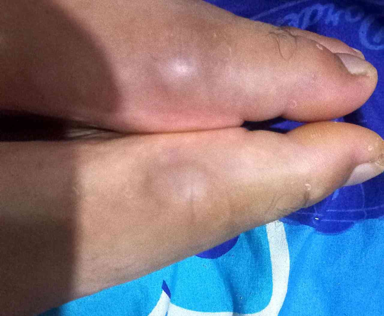 Kondisi benjolan di kaki yang bisa pindah dari kanan ke kiri, hehe/Raja Lubis