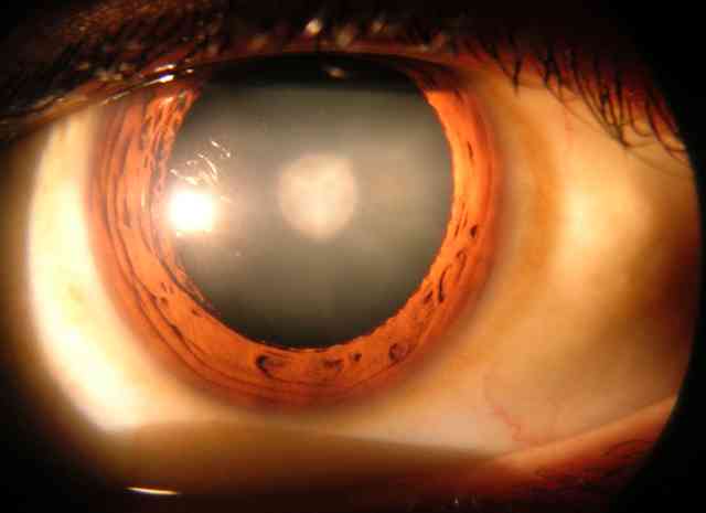 Cataract in Human Eye by Rakesh Ahuja, MD via Wikimedia Commons