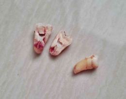 Hasil cabut 2 gigi bungsu. Gigi yang mengalami impaksi dibelah dulu sebelum dicabut (Foto: Dokumentasi pribadi MomAbel)