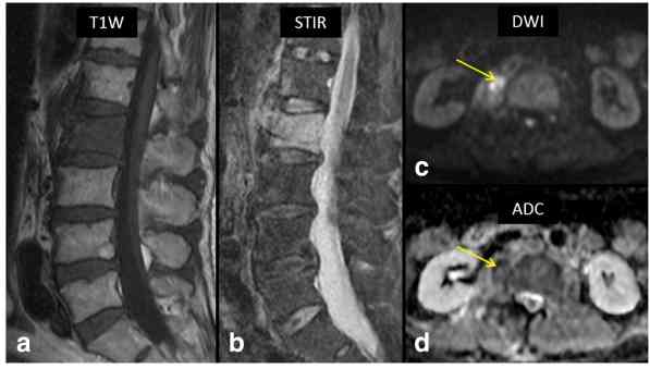 Gambar MRI Sagital T1W (a) dan STIR (b) menunjukkan edema sumsum tulang. Gambar DWI b-value tinggi (1000) (c) menunjukkan paraspinal kanan lesi