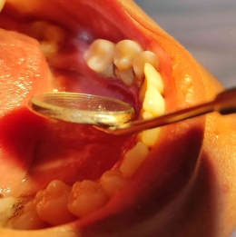 Karang gigi menumpuk di satu sisi rahang (dok. pribadi)