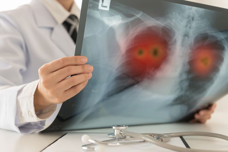 Ilustrasi hasil pemeriksaan hipertensi paru. Sumber: Shutterstock/creat jobs 51 via kompas.com